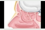 Narrowed frontal sinus opening.